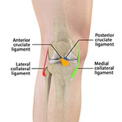 Picture of Multiligament Knee Injuries