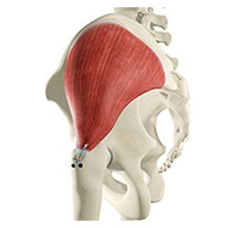 Picture of Open Gluteus Medius Repair