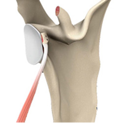 Picture of Open Shoulder Stabilization