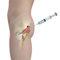 Picture of Orthobiologics for the Hip