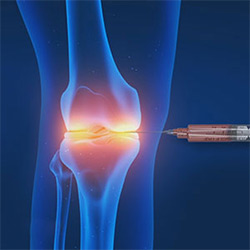 Picture of orthobiologics for the Hip
