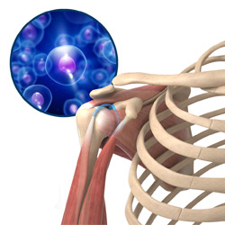 Picture of Orthobiologics Treatment for Shoulders