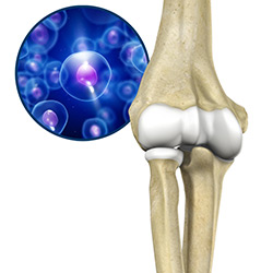 Picture of Orthobiologic Treatments for the Elbow