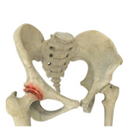 Picture of Osteoarthritis of the Hip