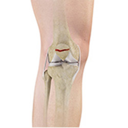 Picture of Patella Fracture