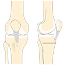Picture of Patella Stabilization