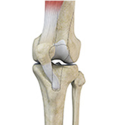 Picture of Patellar Instability