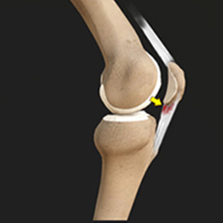 Picture of Patellar Tendonitis