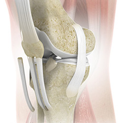Picture of Patellar Tendon Repair