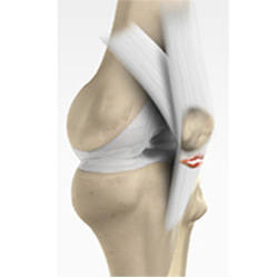Picture of Patellar Tendon Rupture