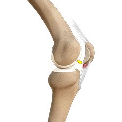 Picture of Patellar Tendon Tear