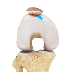 Picture of Patellofemoral Arthritis