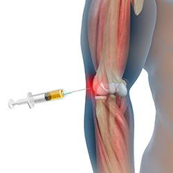 Picture of Platelet-Rich Plasma for the Elbow