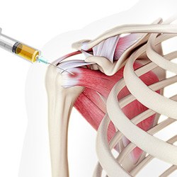 Picture of Platelet-Rich Plasma (PRP) for the shoulder