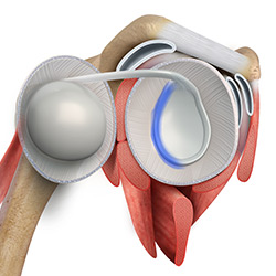 Picture of Posterior Shoulder Labral Repair