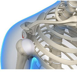 Picture of Posterior Shoulder Stabilization
