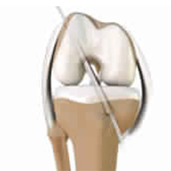 Picture of Primary ACL Repair