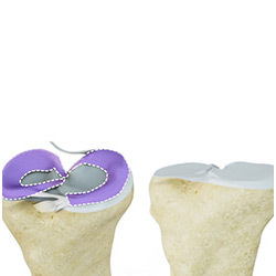 Picture of Prior Meniscectomy