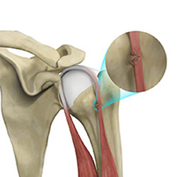 Picture of Proximal Biceps Tendon Rupture