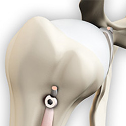 Picture of Proximal Biceps Tendonitis