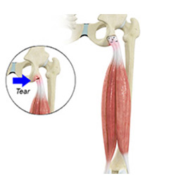 Picture of Proximal Hamstring Repair