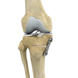 Picture of Proximal Tibial Osteotomy