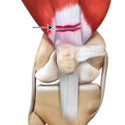 Picture of Quadriceps Tendon Rupture and Repair