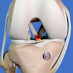 Picture of Revision ACL Surgery