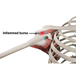 Picture of Rotator Cuff Bursitis