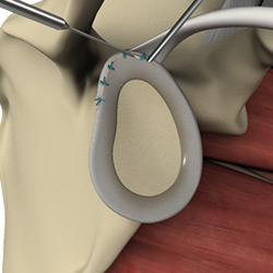 Picture of Shoulder Anterior Labral Repair