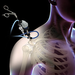 Picture of Shoulder Arthroscopy