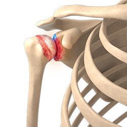 Picture of Shoulder Cartilage Restoration