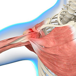 Picture of Shoulder Impingement