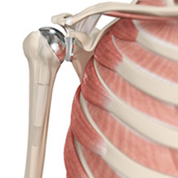 Picture of Shoulder Joint Replacement