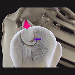 Picture of Shoulder Labral Tear with Instability
