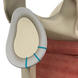 Picture of Shoulder Labrum Reconstruction