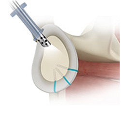 Picture of Shoulder Reconstruction Surgery