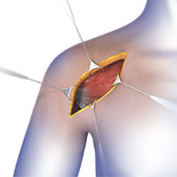 Picture of Shoulder Surgery