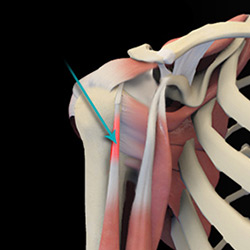 Picture of Shoulder Tendonitis