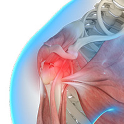 Picture of Shoulder Trauma