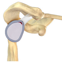 Picture of SLAP Repair