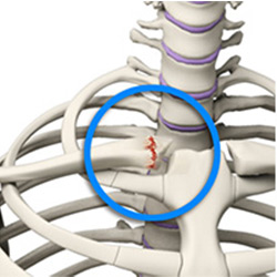 Picture of Sternoclavicular(SC) Joint Injuries