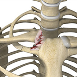 Picture of Sternoclavicular Separation