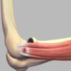 Picture of Tennis Elbow