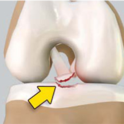 Picture of Tibial Eminence Fracture