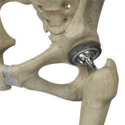 Picture of Total Hip Replacement