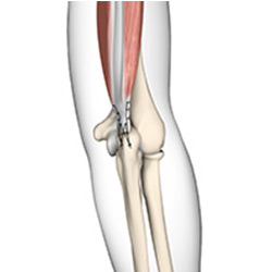 Picture of Triceps Repair