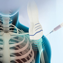 Picture of Ultrasound-guided Injection