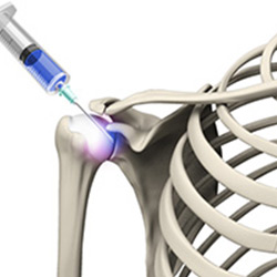 Picture of Viscosupplementation for Shoulder Arthritis