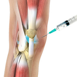 Picture of Viscosupplementation